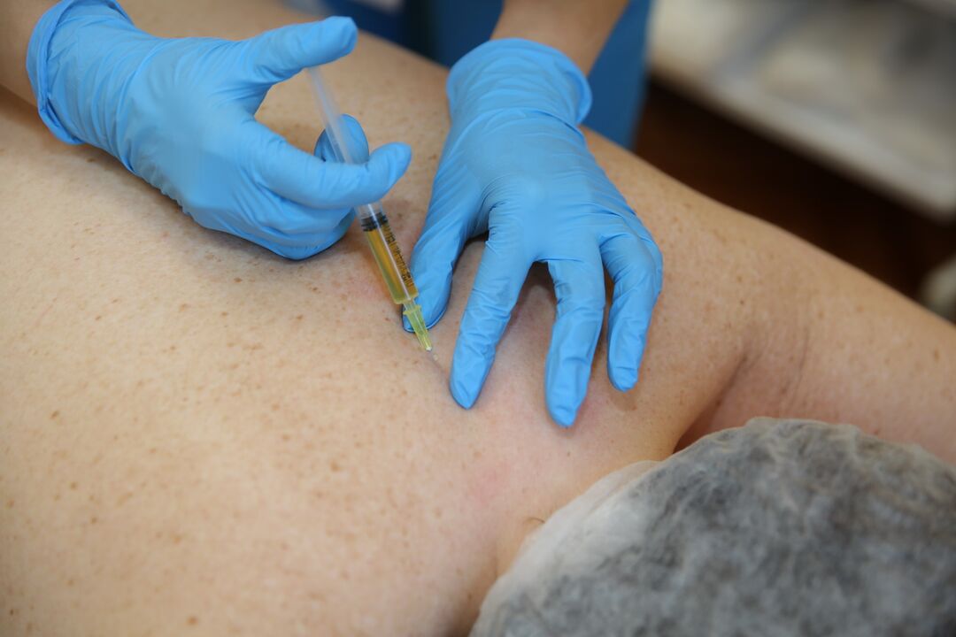 Injections de chondroprotecteurs pour le dos